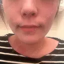 ボトックス（あご） / ボトックス（口角） MAクリニック 心斎橋 DAY 5 サムネイル用