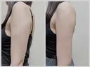 脂肪吸引（二の腕） / 脂肪吸引（肩） 渋谷高野美容医院 DAY 15 サムネイル用