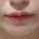 ヒアルロン酸注入（唇） / ボトックス（口角） 上野美容外科・美容皮膚科 AFTER サムネイル用