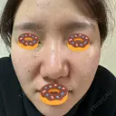 イオン導入 / ルメッカ ルラ美容クリニック 千葉院 / ルラスキンクリニック 千葉院 DAY 4 サムネイル用