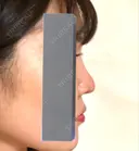 隆鼻術 / 鼻尖形成（切開） / 小鼻縮小（切開） / その他（鼻） / 軟骨移植 / 鼻尖縮小 / 鼻翼基部形成（貴族手術） / 鼻柱下降・鼻唇角形成（猫手術） 東京シンデレラ美容外科 池袋院 DAY 31 サムネイル用