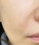 ヒアルロン酸溶解 / ボトックス（目尻） / リジュラン 上野美容外科・美容皮膚科 DAY 0 サムネイル用