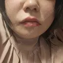 レーザーフェイシャル LIGHT CLINIC 【ライトクリニック】 新宿院 AFTER サムネイル用