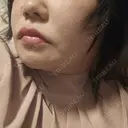 レーザーフェイシャル LIGHT CLINIC 【ライトクリニック】 新宿院 DAY 30 サムネイル用
