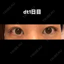 目尻切開 こまちクリニック DAY 2 サムネイル用