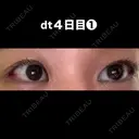 目尻切開 こまちクリニック DAY 4 サムネイル用