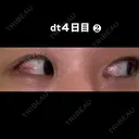 目尻切開 こまちクリニック DAY 4 サムネイル用
