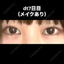 目尻切開 こまちクリニック DAY 7 サムネイル用