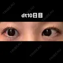 目尻切開 こまちクリニック AFTER サムネイル用