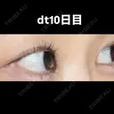 目尻切開 こまちクリニック DAY 10 サムネイル用