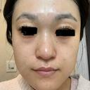 ボトックス（あご） / ボトックス（眉間） / イオン導入 / ピーリング（ハリ・ツヤ） / ルメッカ ルラ美容クリニック 仙台院 / ルラスキンクリニック 仙台院 AFTER サムネイル用