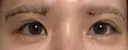 眉下切開 Barbie Clinic DAY 6 サムネイル用
