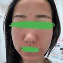 ピコレーザートーニング（美白・肝斑） / ピコフラクショナルレーザー（毛穴・ニキビ跡） おおかみ美容のクリニック 新宿院 AFTER サムネイル用