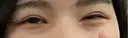 二重切開 / 目頭切開 / 上まぶたたるみ取り 湘南美容クリニック 大阪堺東院 AFTER サムネイル用