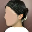 脂肪溶解注射（顔） 仙台N美容クリニック AFTER サムネイル用