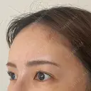 その他（輪郭） / 脂肪注入（額） eクリニック 富山院 DAY 1 サムネイル用
