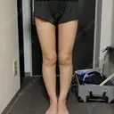 脂肪吸引（脚） / 脂肪吸引（お尻） / ボトックス（ふくらはぎ） Mods Clinic（モッズクリニック） 名古屋院 AFTER サムネイル用