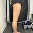 脂肪吸引（脚） / 脂肪吸引（お尻） / ボトックス（ふくらはぎ） Mods Clinic（モッズクリニック） 名古屋院 DAY 170 サムネイル用
