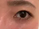 その他（目元） / クマ治療 / 下まぶたの脂肪取り / ヒアルロン酸注入（目の下） ROOTS Clinic DAY 4 サムネイル用