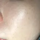 ミラノリピール ミニマムスキンクリニック池袋 DAY 7 サムネイル用