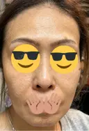 ピコレーザートーニング（美白・肝斑） / フラクショナルレーザー（毛穴・ニキビ跡） Mavie Beauty Clinic （マヴィービューティークリニック） DAY 6 サムネイル用