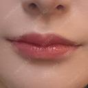ヒアルロン酸注入（唇） R Beauty CLINIC 銀座院 AFTER サムネイル用
