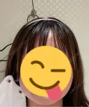 ボトックス（エラ・小顔） メディカルアルファクリニック AFTER サムネイル用