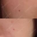 ほくろ・いぼ切除（肌） Belle Via Skin Clinic AFTER サムネイル用