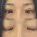 自然癒着法 銀座リシェスクリニック AFTER サムネイル用