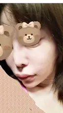 人中短縮 / ヒアルロン酸注入（涙袋） / ヒアルロン酸注入（鼻） / ヒアルロン酸注入（あご） / ヒアルロン酸注入（唇） / ヒアルロン酸注入（頬） / その他（輪郭） 共立美容外科 神戸三宮院 DAY 1 サムネイル用