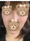 人中短縮 / ヒアルロン酸注入（涙袋） / ヒアルロン酸注入（鼻） / ヒアルロン酸注入（あご） / ヒアルロン酸注入（唇） / ヒアルロン酸注入（頬） / その他（輪郭） 共立美容外科 神戸三宮院 DAY 1 サムネイル用