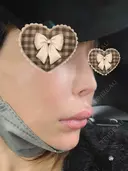 人中短縮 / ヒアルロン酸注入（涙袋） / ヒアルロン酸注入（鼻） / ヒアルロン酸注入（あご） / ヒアルロン酸注入（唇） / ヒアルロン酸注入（頬） / その他（輪郭） 共立美容外科 神戸三宮院 DAY 1 サムネイル用