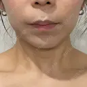 ハイフ（顔） 新宿中央クリニック AFTER サムネイル用