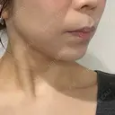 ハイフ（顔） 新宿中央クリニック DAY 25 サムネイル用