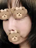 人中短縮 / ヒアルロン酸注入（涙袋） / ヒアルロン酸注入（鼻） / ヒアルロン酸注入（あご） / ヒアルロン酸注入（唇） / ヒアルロン酸注入（頬） / その他（輪郭） 共立美容外科 神戸三宮院 DAY 2 サムネイル用