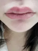 人中短縮 / ヒアルロン酸注入（涙袋） / ヒアルロン酸注入（鼻） / ヒアルロン酸注入（あご） / ヒアルロン酸注入（唇） / ヒアルロン酸注入（頬） / その他（輪郭） 共立美容外科 神戸三宮院 DAY 2 サムネイル用