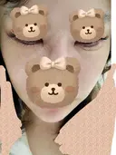 人中短縮 / ヒアルロン酸注入（涙袋） / ヒアルロン酸注入（鼻） / ヒアルロン酸注入（あご） / ヒアルロン酸注入（唇） / ヒアルロン酸注入（頬） / その他（輪郭） 共立美容外科 神戸三宮院 DAY 2 サムネイル用