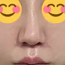 鼻尖形成（切開） / 人中短縮 / 鼻孔縁挙上 / その他（鼻） アリエル美容クリニック 大宮院 DAY 61 サムネイル用