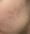 その他（肌） / 美肌レーザー こまちクリニック DAY 14 サムネイル用