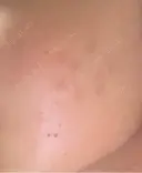 その他（肌） / 美肌レーザー こまちクリニック DAY 15 サムネイル用