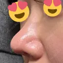 鼻尖形成（切開） / 軟骨移植 / 鼻尖縮小 / 鼻翼基部形成（貴族手術） / ヒアルロン酸注入（鼻翼基部） 東京シンデレラ美容外科 新宿院 DAY 31 サムネイル用