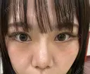 二重埋没 / 隆鼻術 / 鼻尖形成（切開） / 小鼻縮小（切開） / 軟骨移植 R Beauty CLINIC 名古屋院 DAY 51 サムネイル用