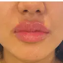 ヒアルロン酸注入（唇） 麻布十番クレールデンタルクリニック AFTER サムネイル用