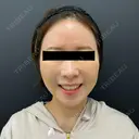 糸リフト / 脂肪吸引（顔） / メーラーファット除去 BLINC CLINIC （ブリンク クリニック） DAY 6 サムネイル用