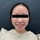 糸リフト / 脂肪吸引（顔） / メーラーファット除去 BLINC CLINIC （ブリンク クリニック） AFTER サムネイル用