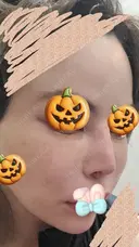 人中短縮 / ヒアルロン酸注入（涙袋） / ヒアルロン酸注入（鼻） / ヒアルロン酸注入（あご） / ヒアルロン酸注入（唇） / ヒアルロン酸注入（頬） / その他（輪郭） 共立美容外科 神戸三宮院 DAY 5 サムネイル用