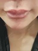 人中短縮 / ヒアルロン酸注入（涙袋） / ヒアルロン酸注入（鼻） / ヒアルロン酸注入（あご） / ヒアルロン酸注入（唇） / ヒアルロン酸注入（頬） / その他（輪郭） 共立美容外科 神戸三宮院 AFTER サムネイル用