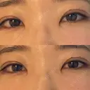 二重埋没 宇都宮竹内クリニック AFTER サムネイル用