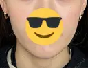糸リフト 仙台N美容クリニック AFTER サムネイル用