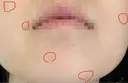 ほくろ・いぼ切除（肌） KARIS beauty clinic AFTER サムネイル用